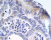 Genetic basis for a type of hereditary colon cancer