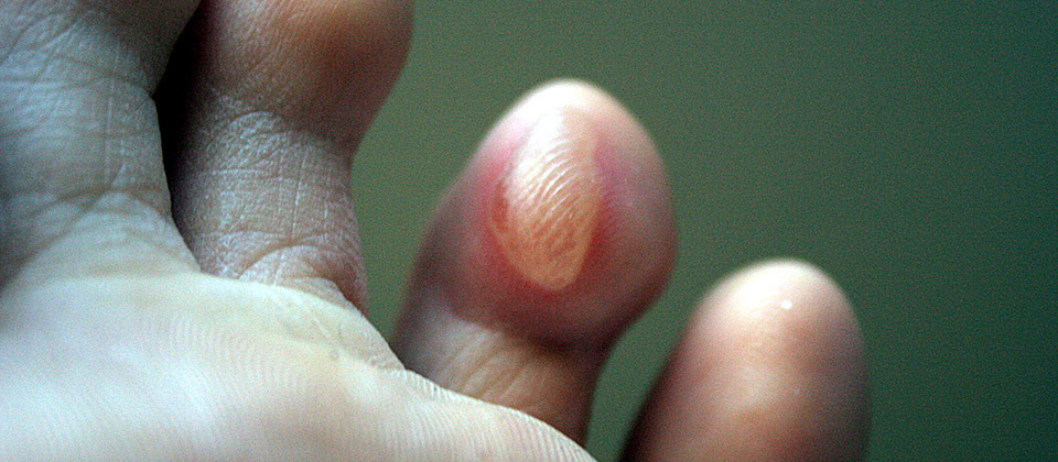 You shouldn't pop blisters | Office for Science and Society - McGill  University