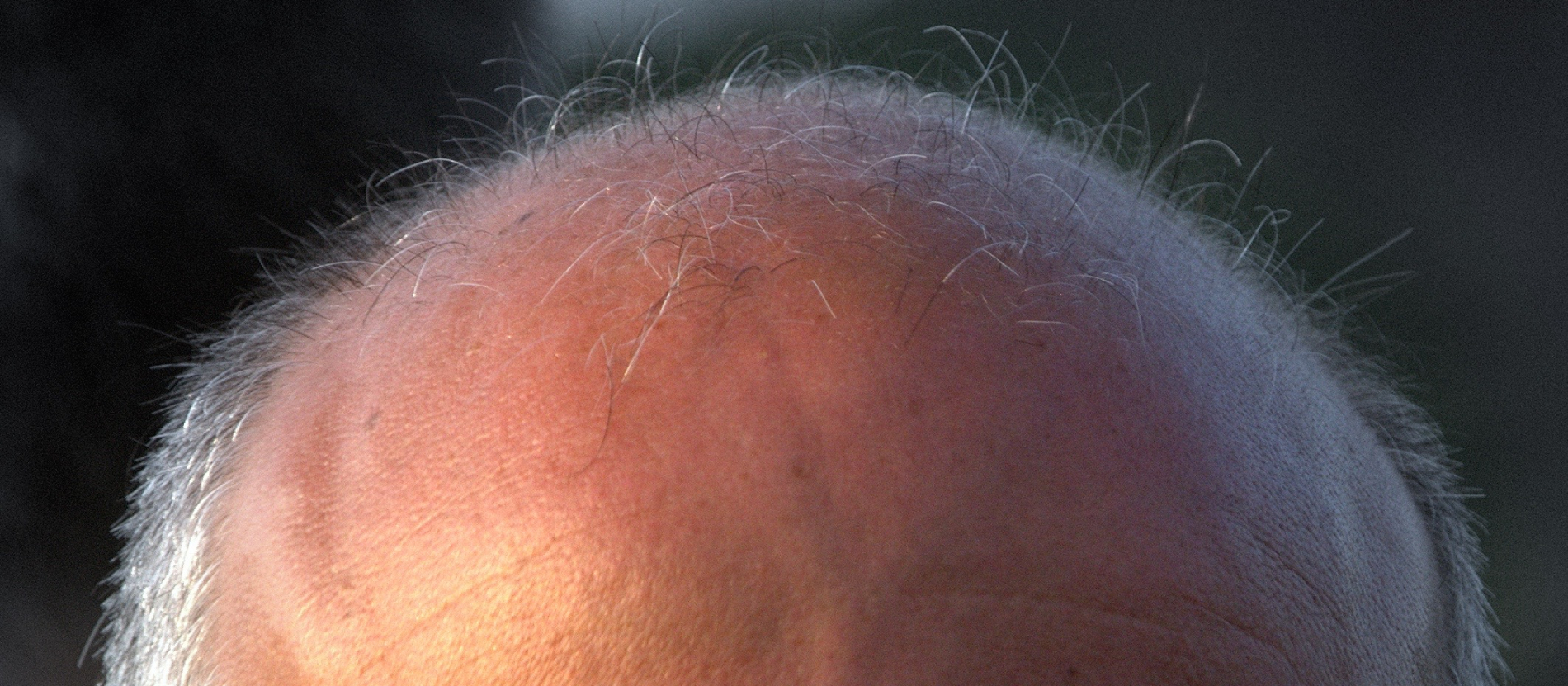 The Bald Truth About Hair-Loss Treatments | Office for Science and Society  - McGill University