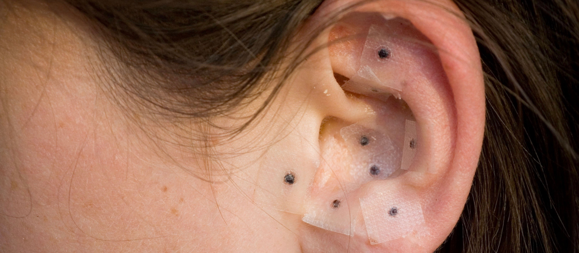 Everything to Know About Ear Seeding Before You Try It